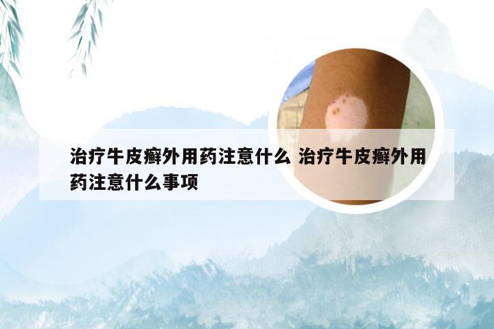 治疗牛皮癣外用药注意什么 治疗牛皮癣外用药注意什么事项