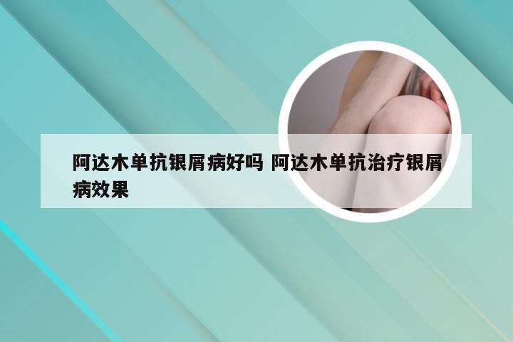阿达木单抗银屑病好吗 阿达木单抗治疗银屑病效果