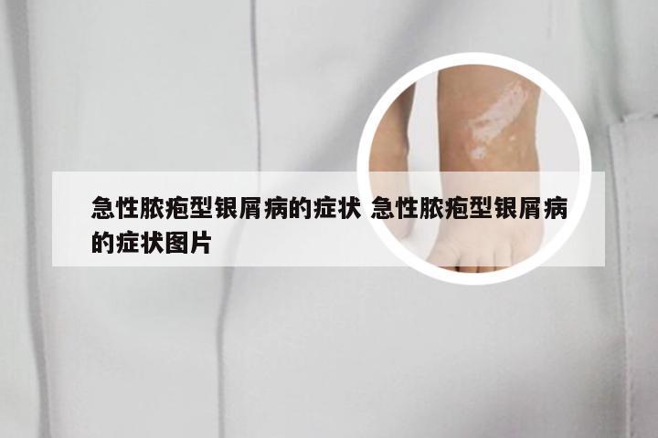 急性脓疱型银屑病的症状 急性脓疱型银屑病的症状图片