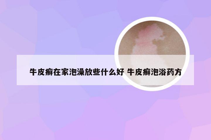 牛皮癣在家泡澡放些什么好 牛皮癣泡浴药方