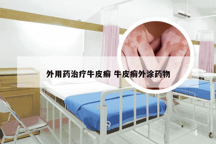 外用药治疗牛皮癣 牛皮癣外涂药物