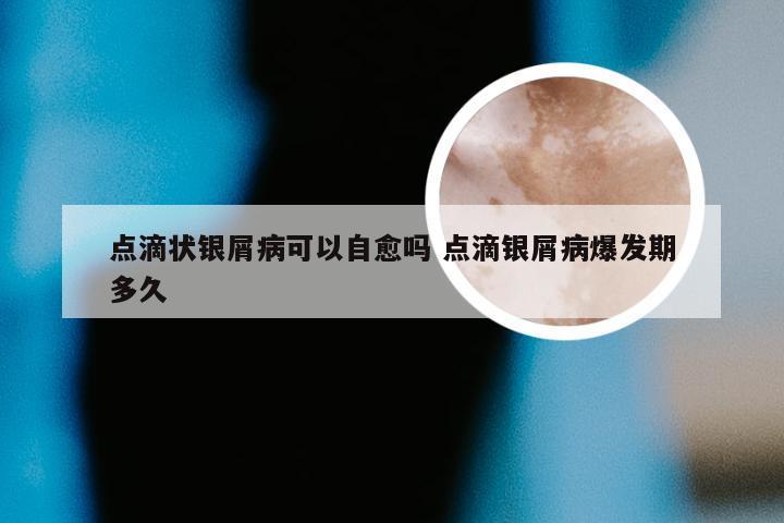 点滴状银屑病可以自愈吗 点滴银屑病爆发期多久