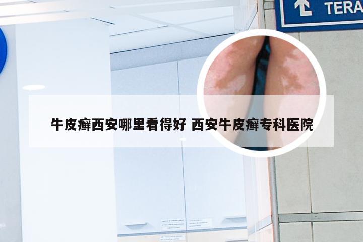 牛皮癣西安哪里看得好 西安牛皮癣专科医院