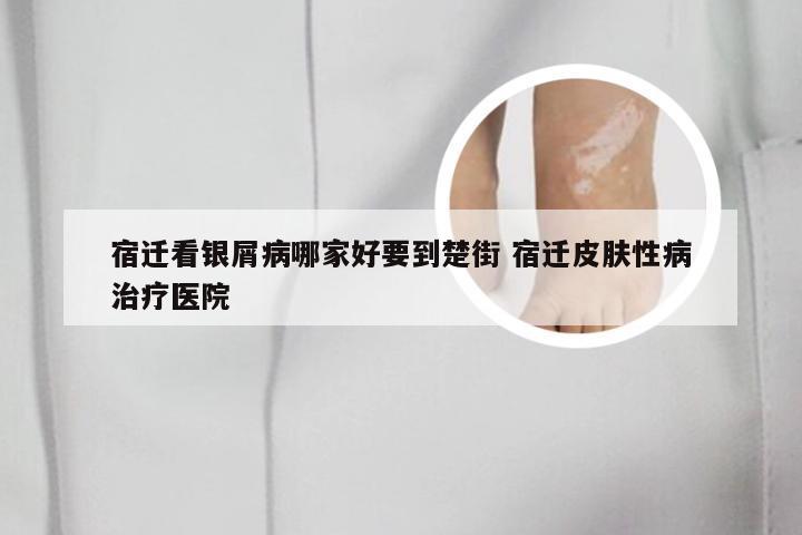 宿迁看银屑病哪家好要到楚街 宿迁皮肤性病治疗医院