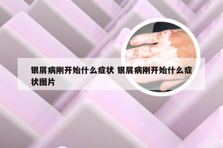 银屑病刚开始什么症状 银屑病刚开始什么症状图片
