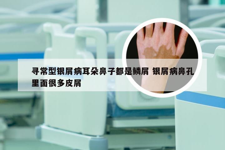 寻常型银屑病耳朵鼻子都是鳞屑 银屑病鼻孔里面很多皮屑