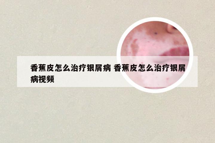 香蕉皮怎么治疗银屑病 香蕉皮怎么治疗银屑病视频