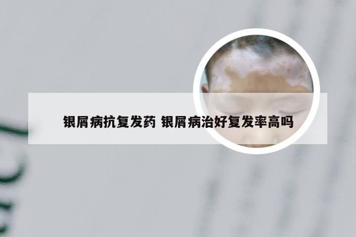 银屑病抗复发药 银屑病治好复发率高吗