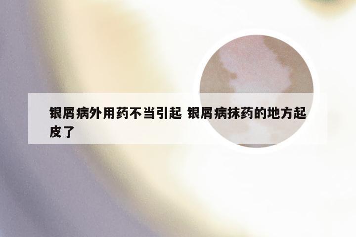 银屑病外用药不当引起 银屑病抹药的地方起皮了
