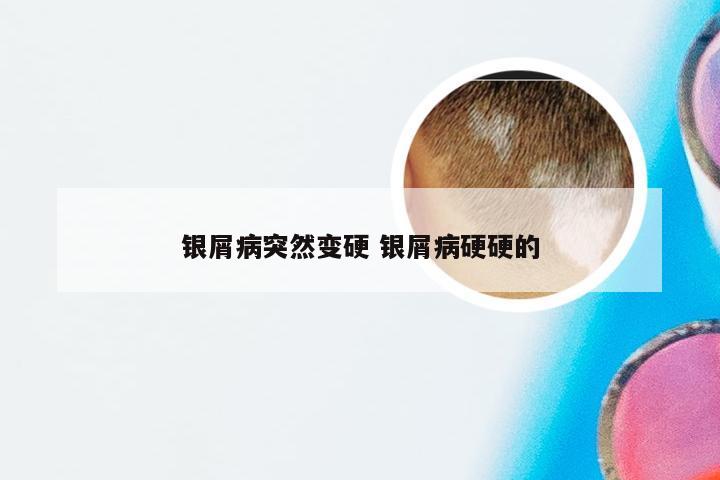 银屑病突然变硬 银屑病硬硬的