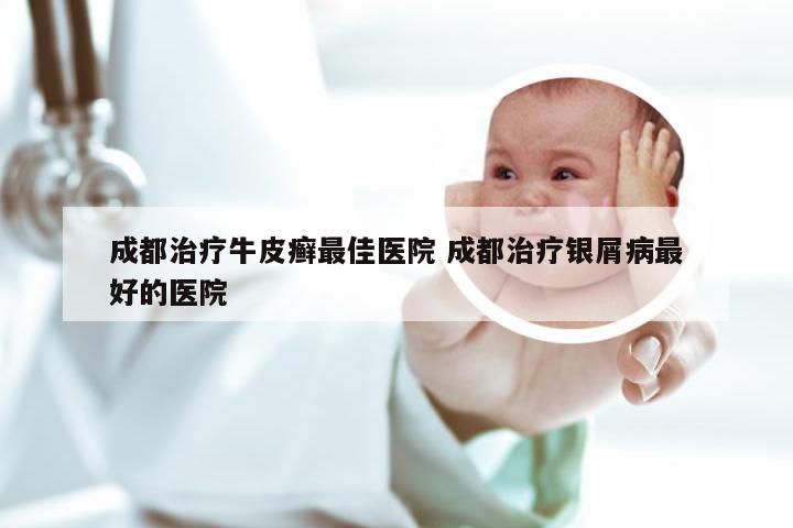 成都治疗牛皮癣最佳医院 成都治疗银屑病最好的医院