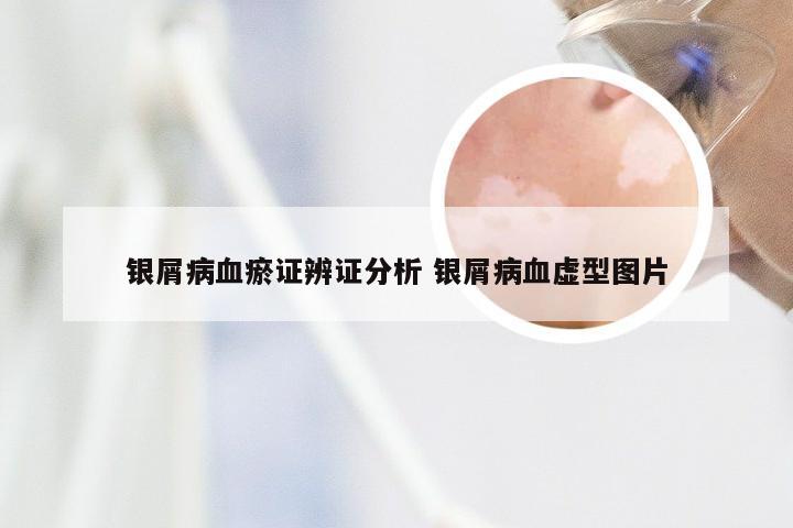 银屑病血瘀证辨证分析 银屑病血虚型图片
