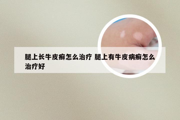 腿上长牛皮癣怎么治疗 腿上有牛皮病癣怎么治疗好