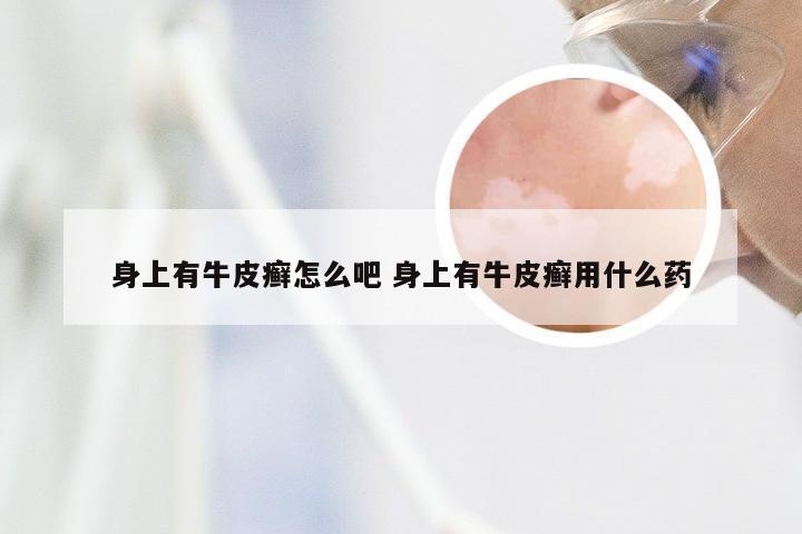 身上有牛皮癣怎么吧 身上有牛皮癣用什么药