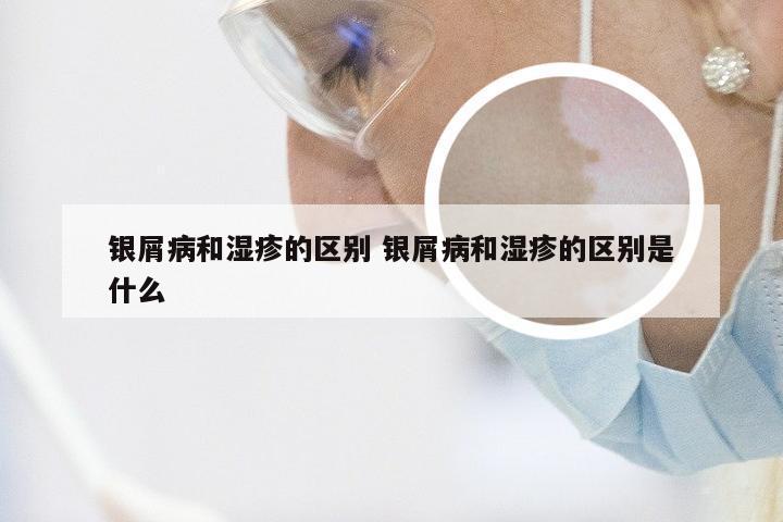 银屑病和湿疹的区别 银屑病和湿疹的区别是什么