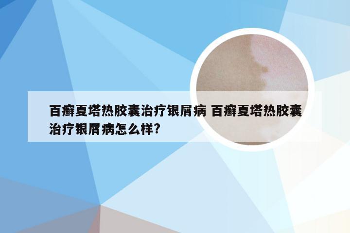 百癣夏塔热胶囊治疗银屑病 百癣夏塔热胶囊治疗银屑病怎么样?