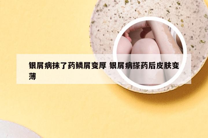 银屑病抹了药鳞屑变厚 银屑病搽药后皮肤变薄