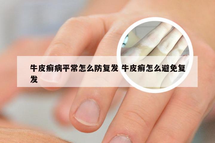 牛皮癣病平常怎么防复发 牛皮癣怎么避免复发