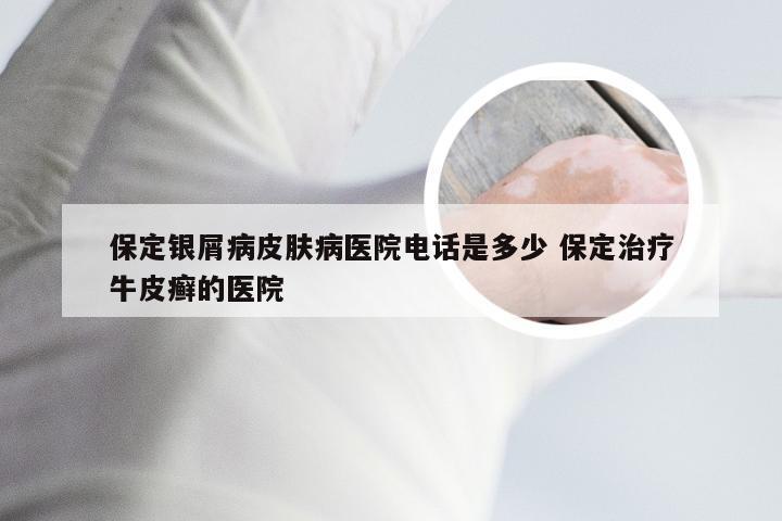 保定银屑病皮肤病医院电话是多少 保定治疗牛皮癣的医院