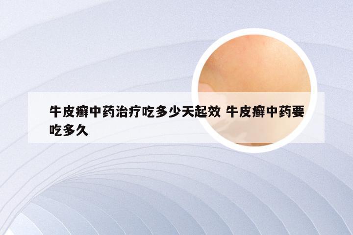 牛皮癣中药治疗吃多少天起效 牛皮癣中药要吃多久