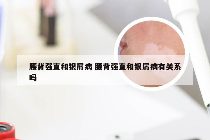 腰背强直和银屑病 腰背强直和银屑病有关系吗