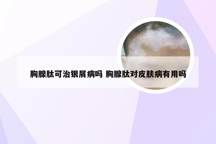 胸腺肽可治银屑病吗 胸腺肽对皮肤病有用吗