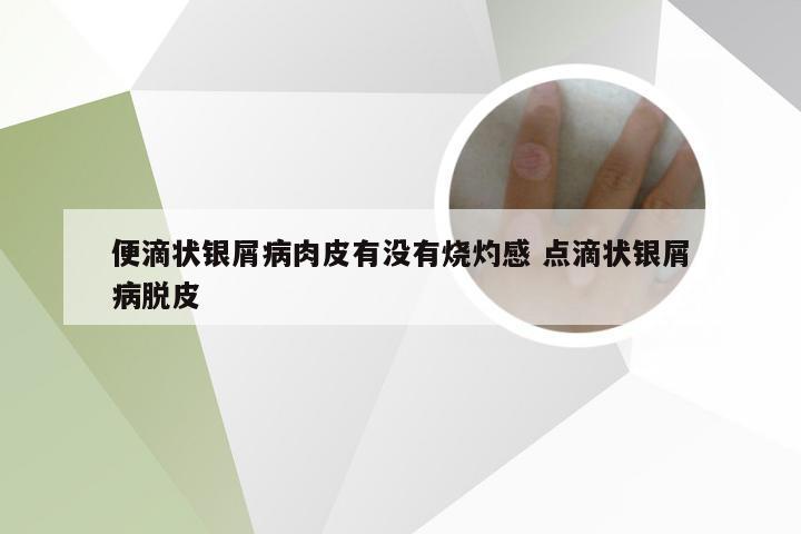 便滴状银屑病肉皮有没有烧灼感 点滴状银屑病脱皮