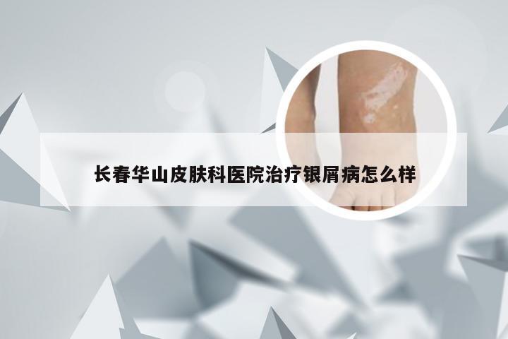 长春华山皮肤科医院治疗银屑病怎么样