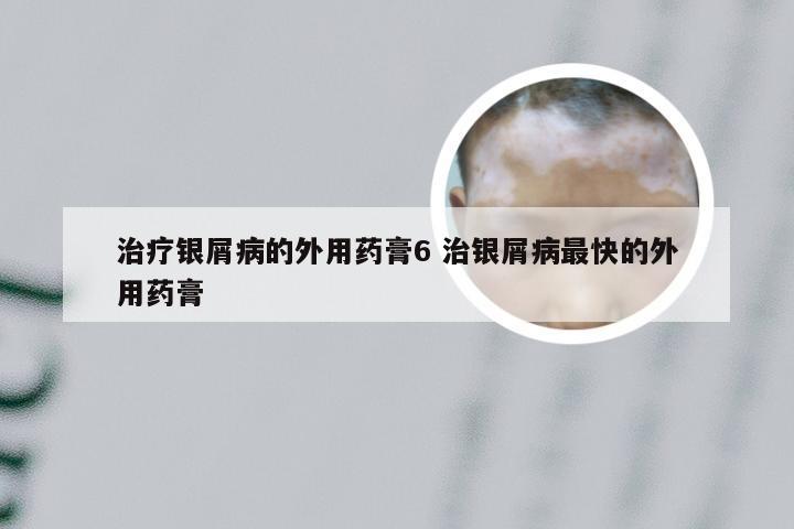 治疗银屑病的外用药膏6 治银屑病最快的外用药膏