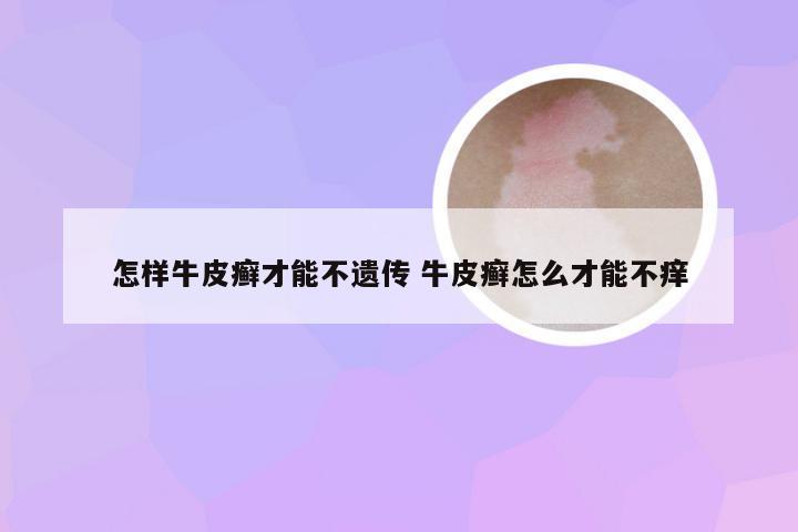 怎样牛皮癣才能不遗传 牛皮癣怎么才能不痒