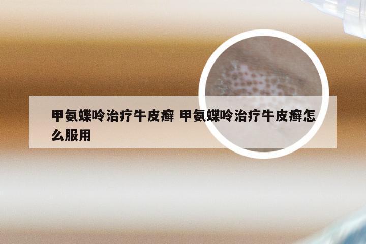 甲氨蝶呤治疗牛皮癣 甲氨蝶呤治疗牛皮癣怎么服用