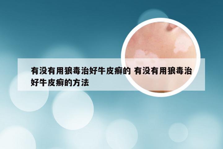 有没有用狼毒治好牛皮癣的 有没有用狼毒治好牛皮癣的方法
