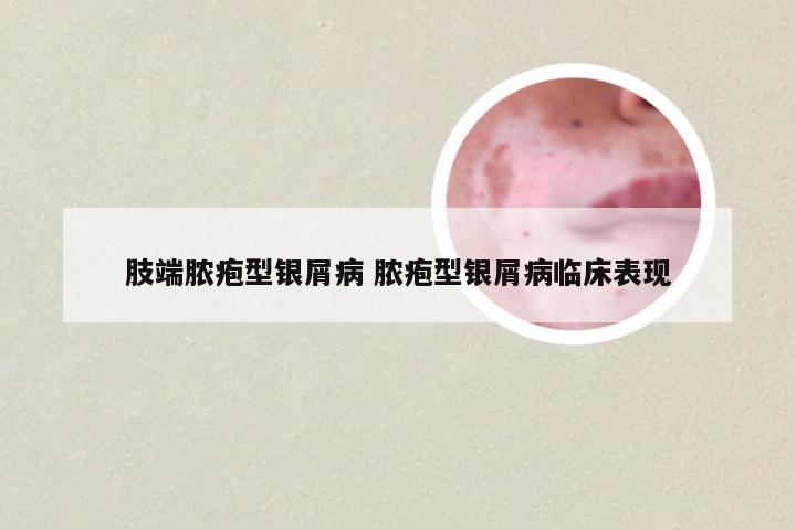 肢端脓疱型银屑病 脓疱型银屑病临床表现