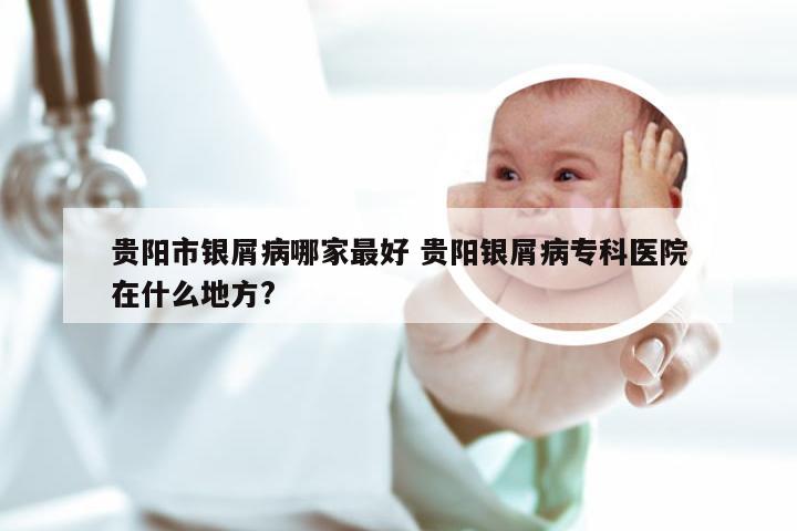 贵阳市银屑病哪家最好 贵阳银屑病专科医院在什么地方?
