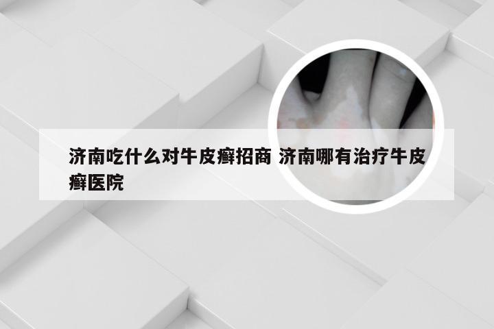 济南吃什么对牛皮癣招商 济南哪有治疗牛皮癣医院