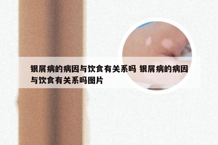 银屑病的病因与饮食有关系吗 银屑病的病因与饮食有关系吗图片
