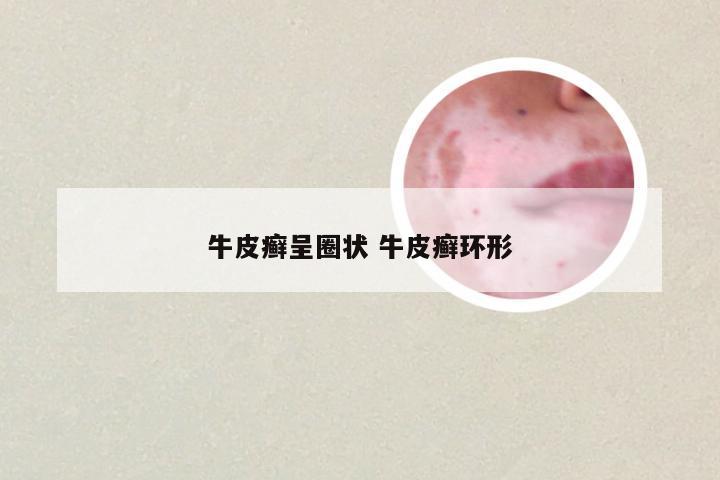 牛皮癣呈圈状 牛皮癣环形