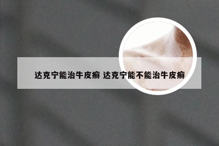 达克宁能治牛皮癣 达克宁能不能治牛皮癣