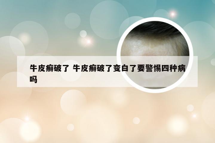 牛皮癣破了 牛皮癣破了变白了要警惕四种病吗