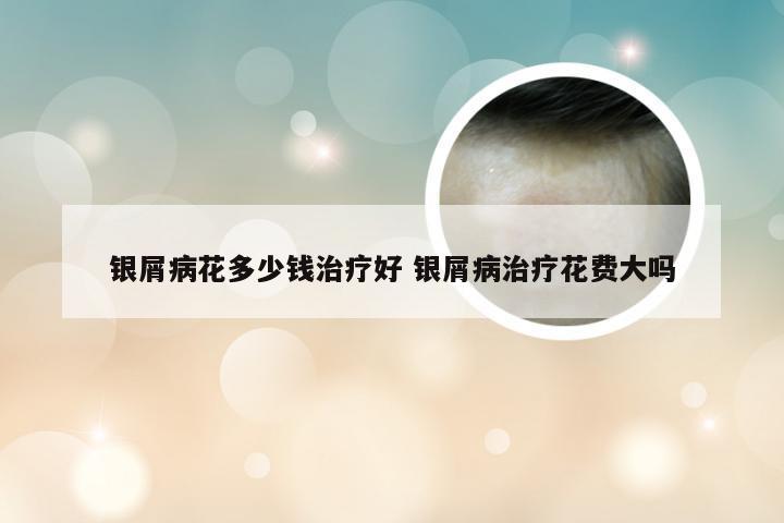 银屑病花多少钱治疗好 银屑病治疗花费大吗