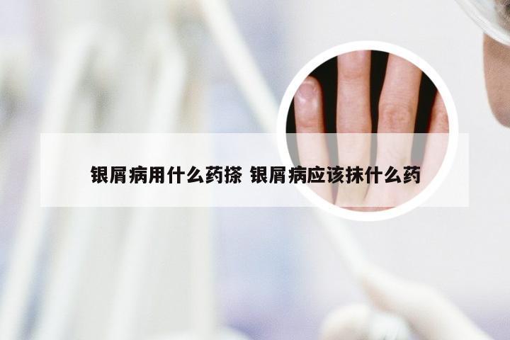银屑病用什么药搽 银屑病应该抹什么药