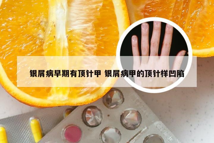 银屑病早期有顶针甲 银屑病甲的顶针样凹陷