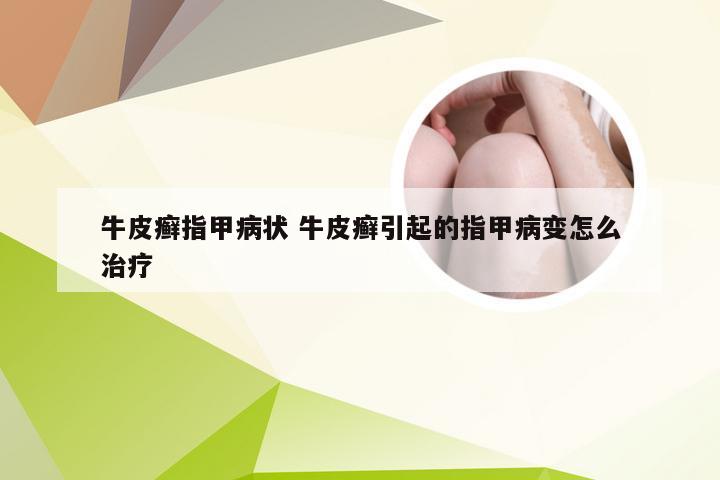 牛皮癣指甲病状 牛皮癣引起的指甲病变怎么治疗