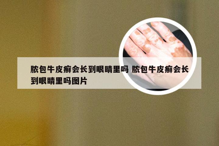脓包牛皮癣会长到眼睛里吗 脓包牛皮癣会长到眼睛里吗图片