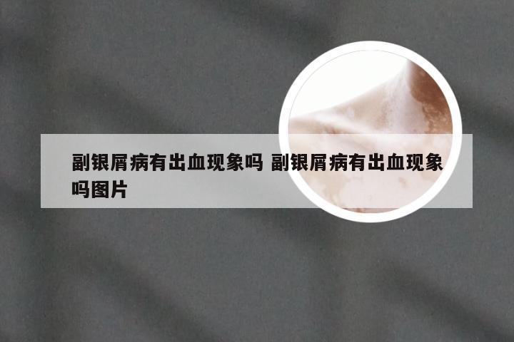 副银屑病有出血现象吗 副银屑病有出血现象吗图片