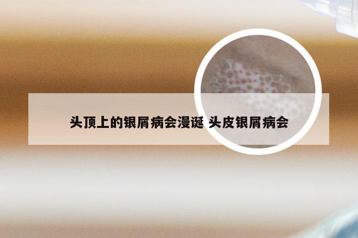 头顶上的银屑病会漫诞 头皮银屑病会