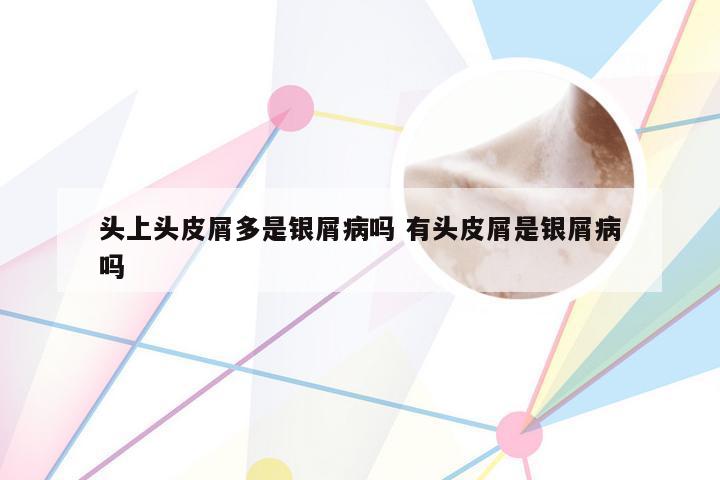 头上头皮屑多是银屑病吗 有头皮屑是银屑病吗