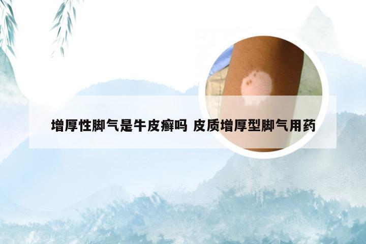 增厚性脚气是牛皮癣吗 皮质增厚型脚气用药