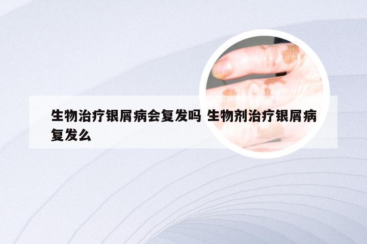 生物治疗银屑病会复发吗 生物剂治疗银屑病复发么