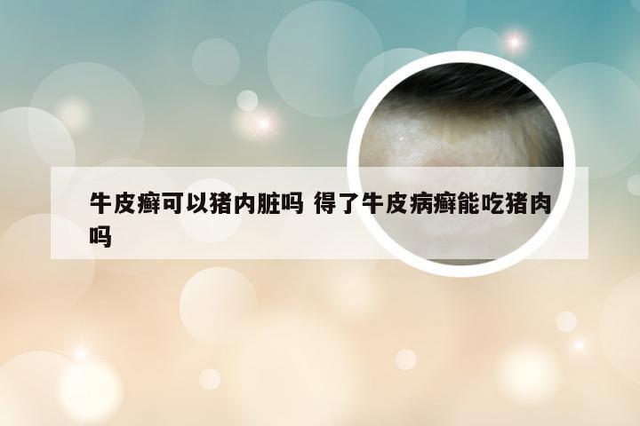 牛皮癣可以猪内脏吗 得了牛皮病癣能吃猪肉吗